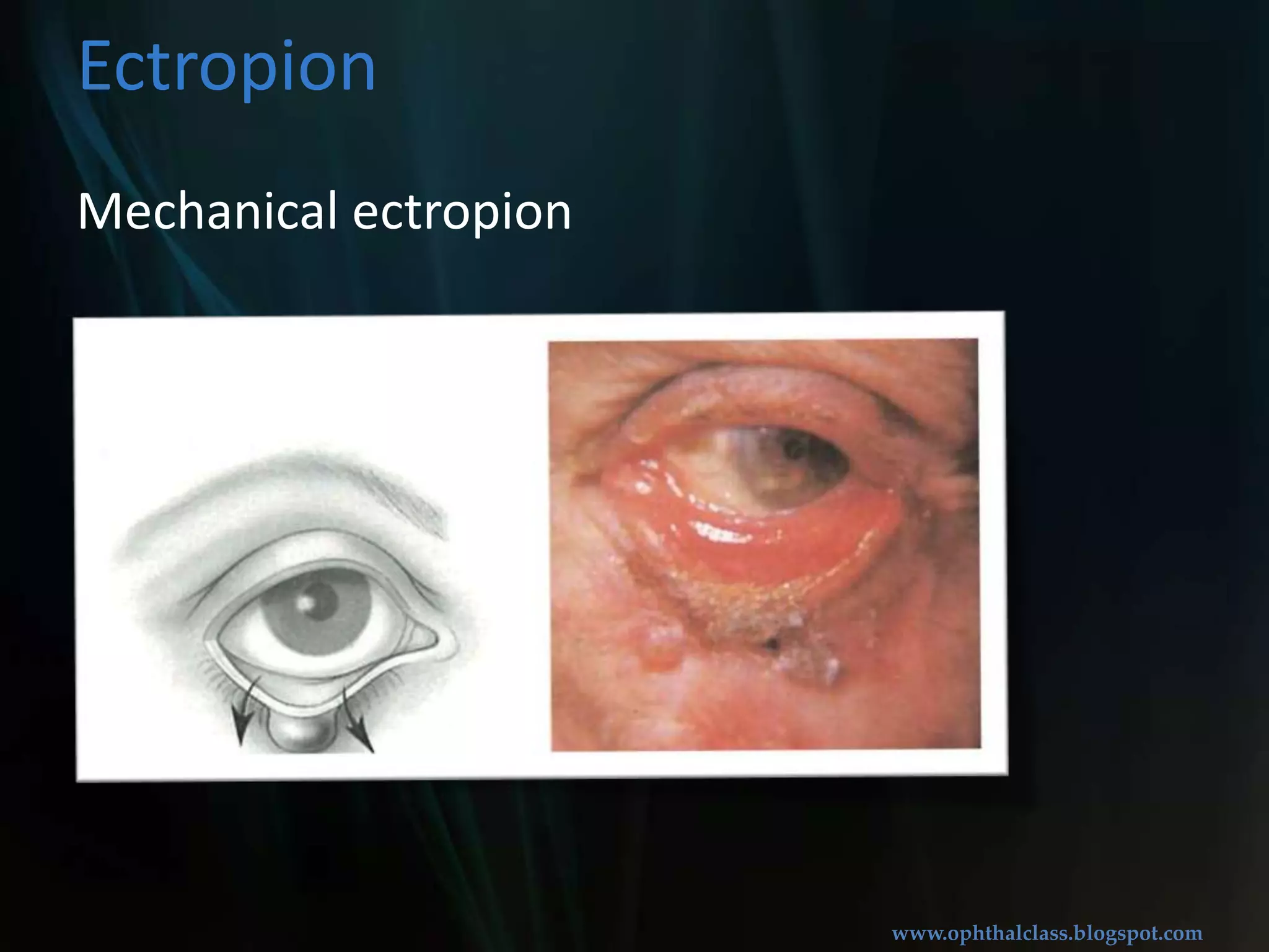 CicatricialectropionEctropion