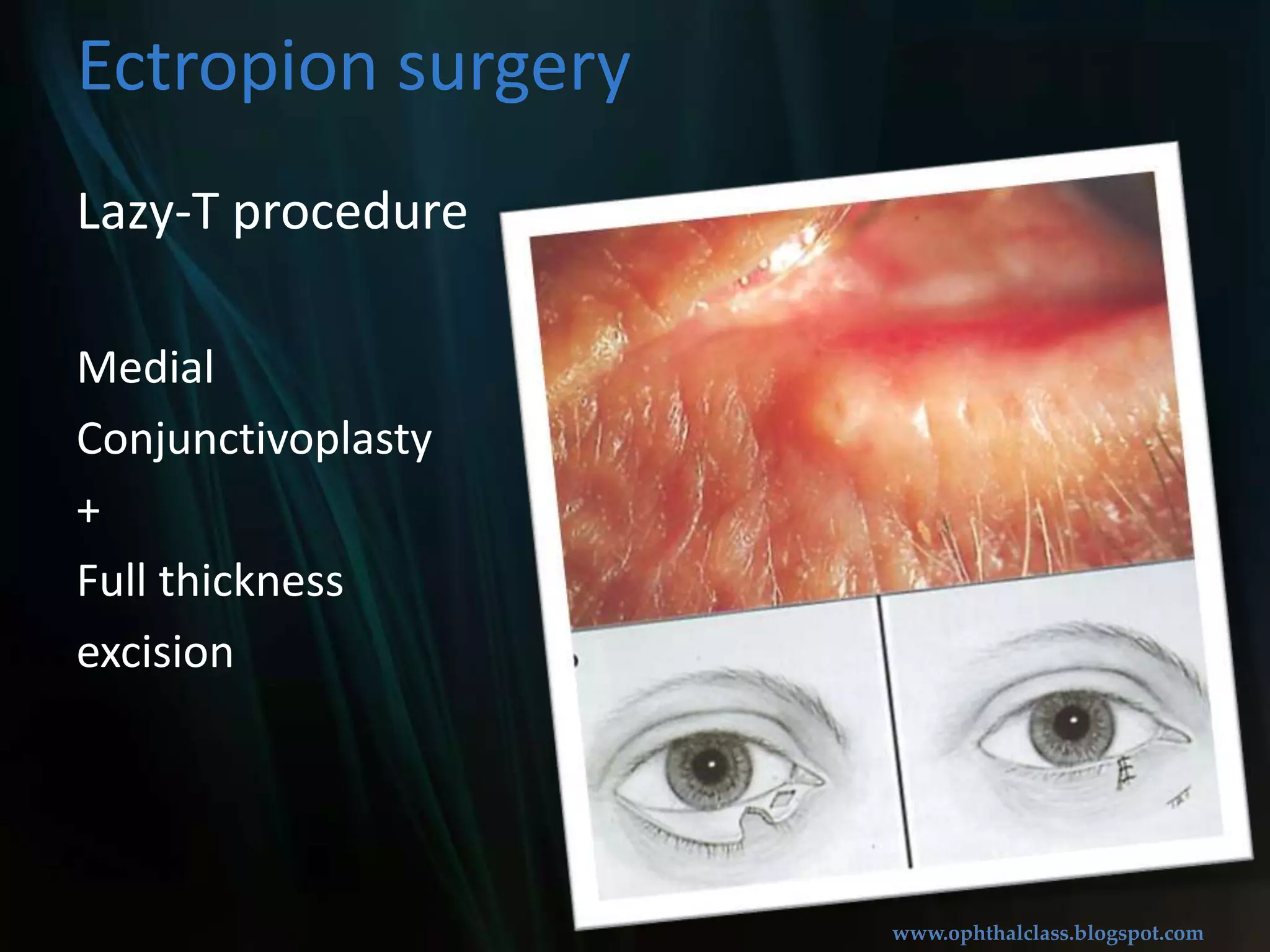 Medial conjunctivoplasty / Medial spindle procedureEctropion surgeryLateral canthoplasty / Lateral tarsal strip procedure