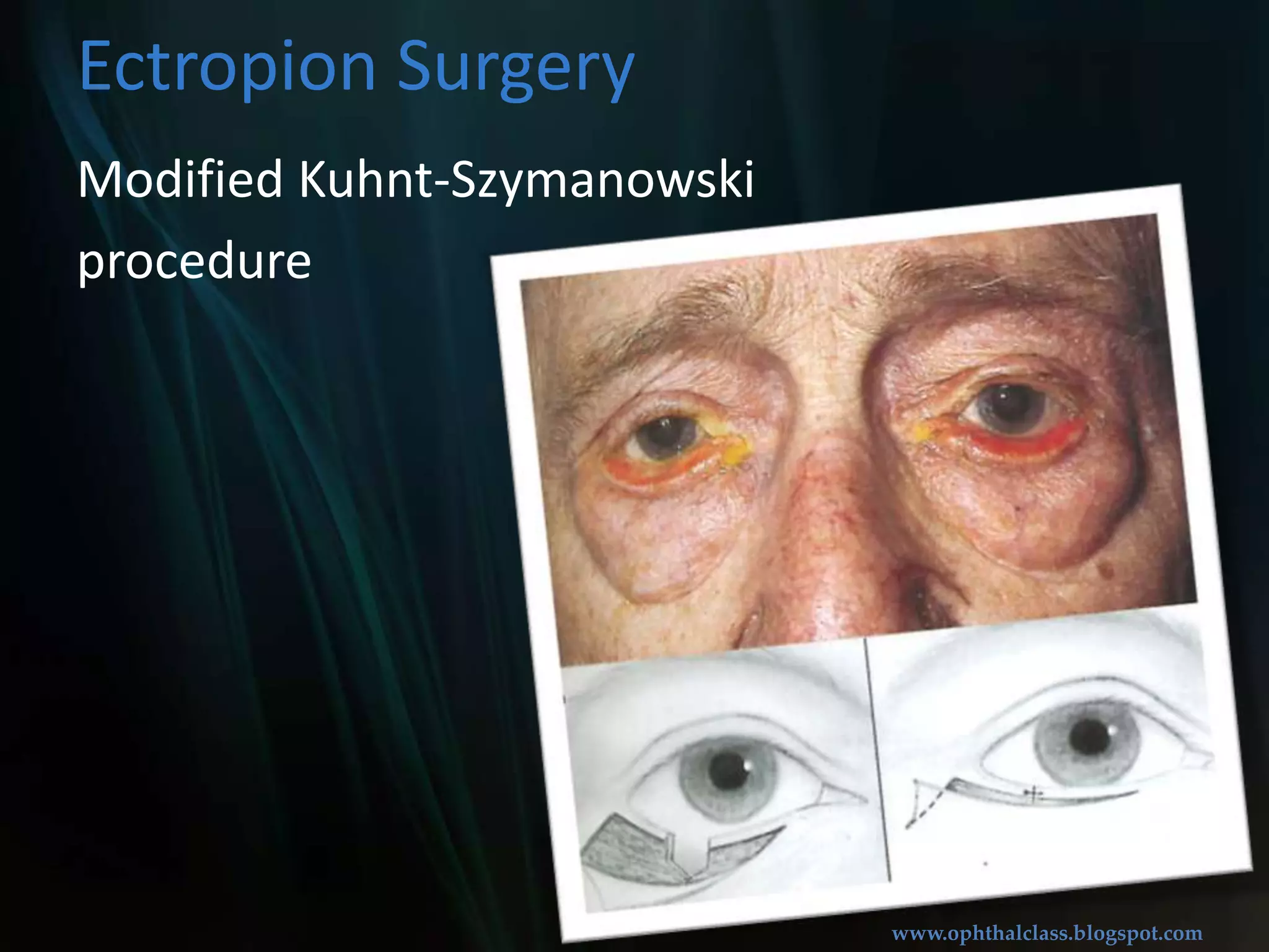 Lazy-T procedureMedialConjunctivoplasty+Full thickness excisionEctropion surgery