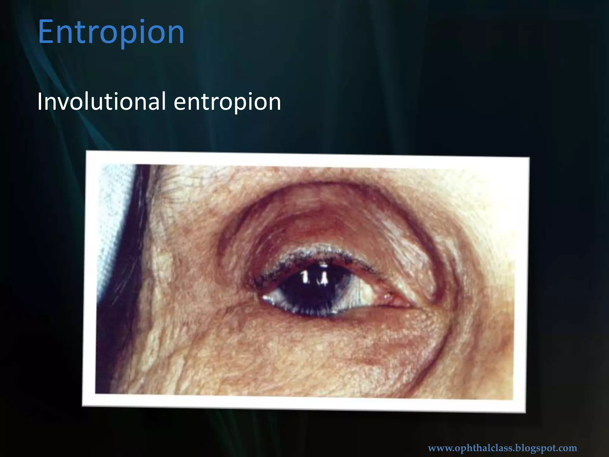 Inversion of eyelid marginTypesCongenitalAcute spasticInvolutionalCicatricialLower lid involutionalentropion is more common Entropion