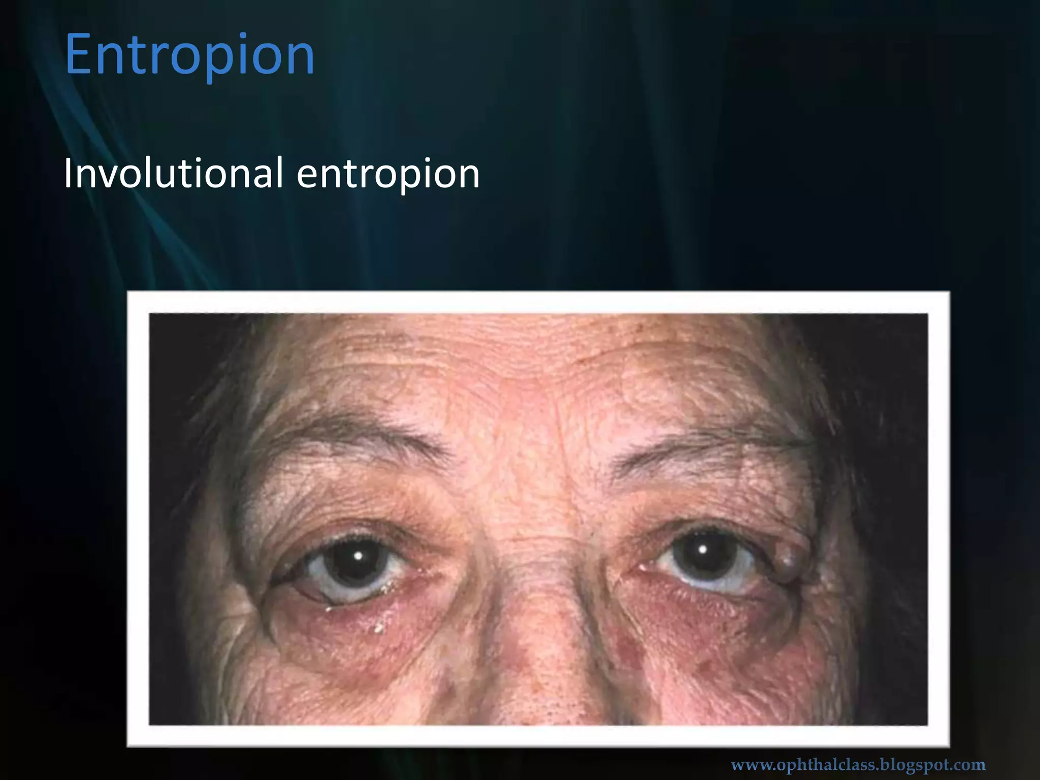 InvolutionalentropionEntropion