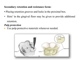 Class 2 amalgam restoration | PPTX
