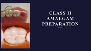 CLASS II
AMALGAM
PREPARATION
 