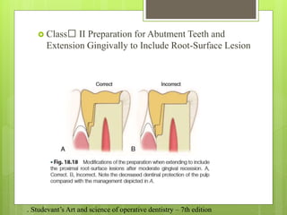  Class﻿
﻿ II Preparation for Abutment Teeth and
Extension Gingivally to Include Root-Surface Lesion
. Studevant’s Art and science of operative dentistry – 7th edition
 