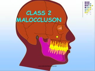 CLASS 2
MALOCCLUSON

www.indiandentalacademy.com

 