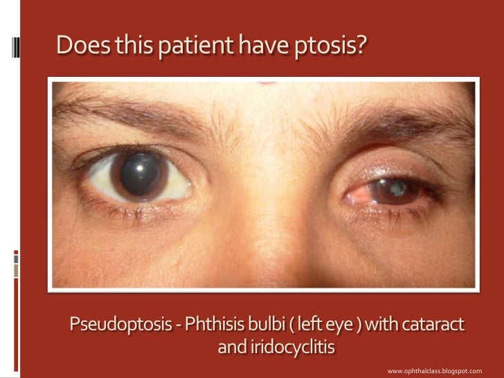 Lids and Adnexa Class3 - Ptosis