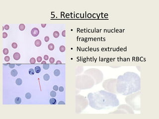 5. Reticulocyte
• Reticular nuclear
fragments
• Nucleus extruded
• Slightly larger than RBCs
 