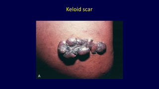 Keloid scar
 