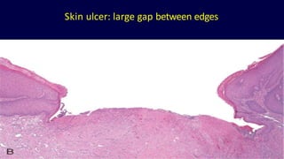 Skin ulcer: large gap between edges
 