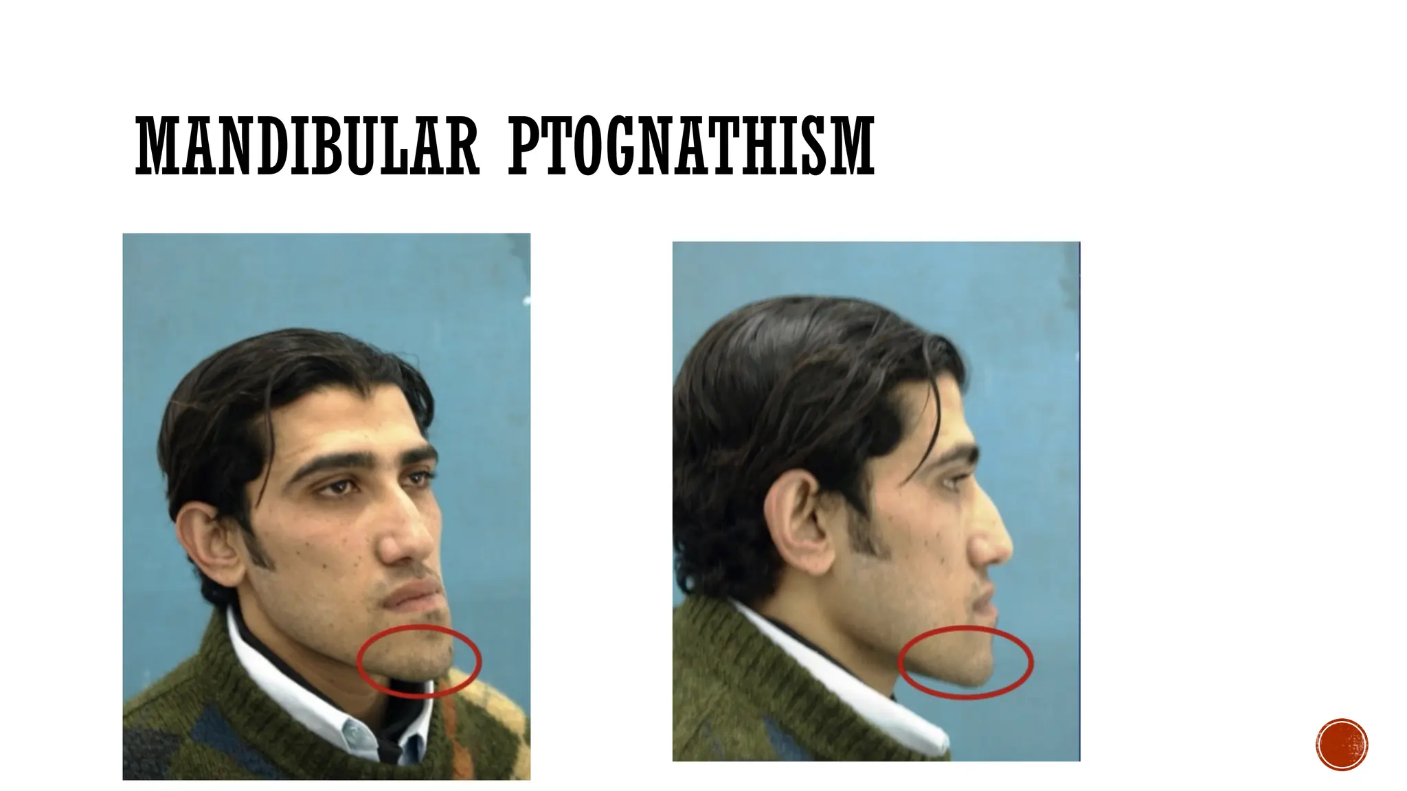 MANDIBULAR PTOGNATHISM
 