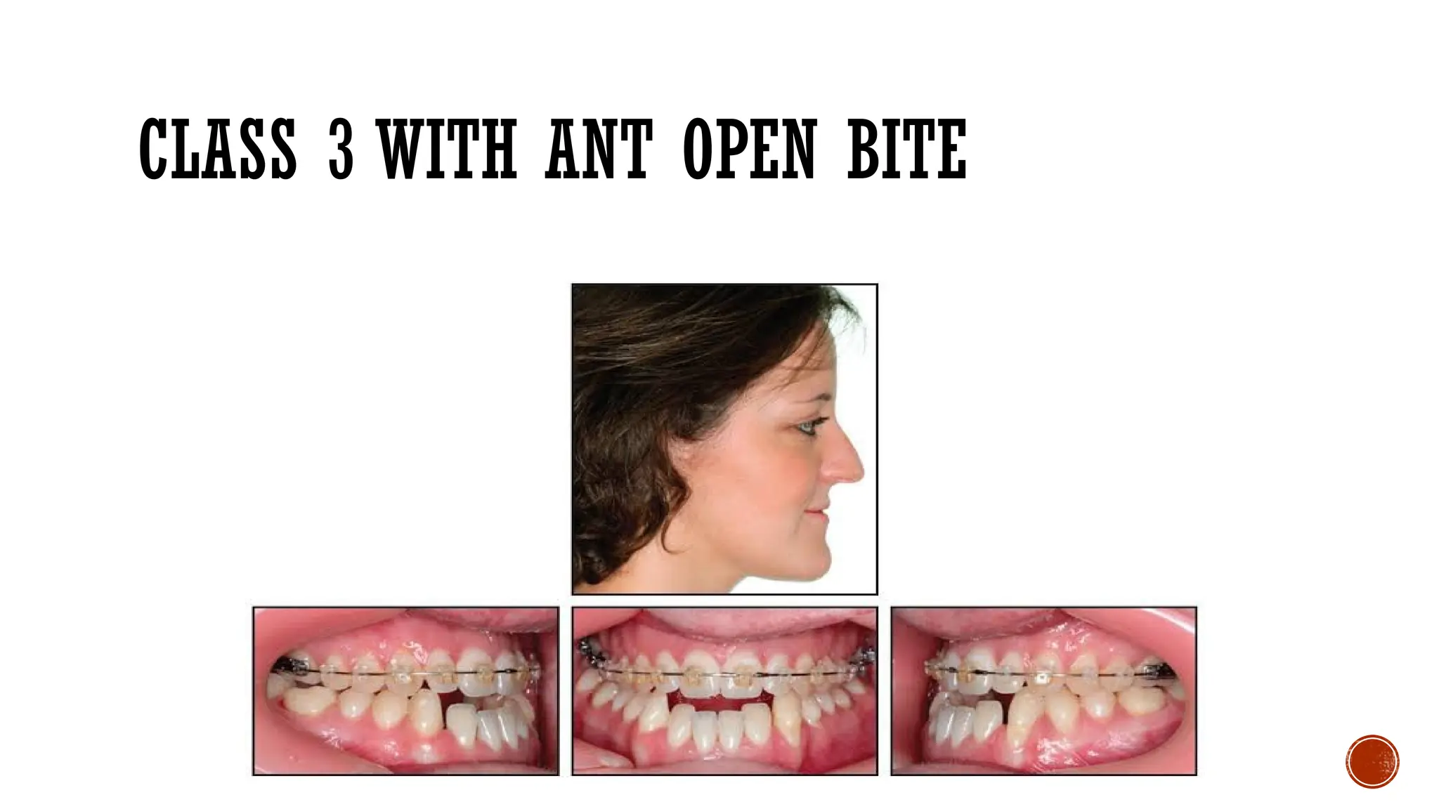 CLASS 3 WITH ANT OPEN BITE
 