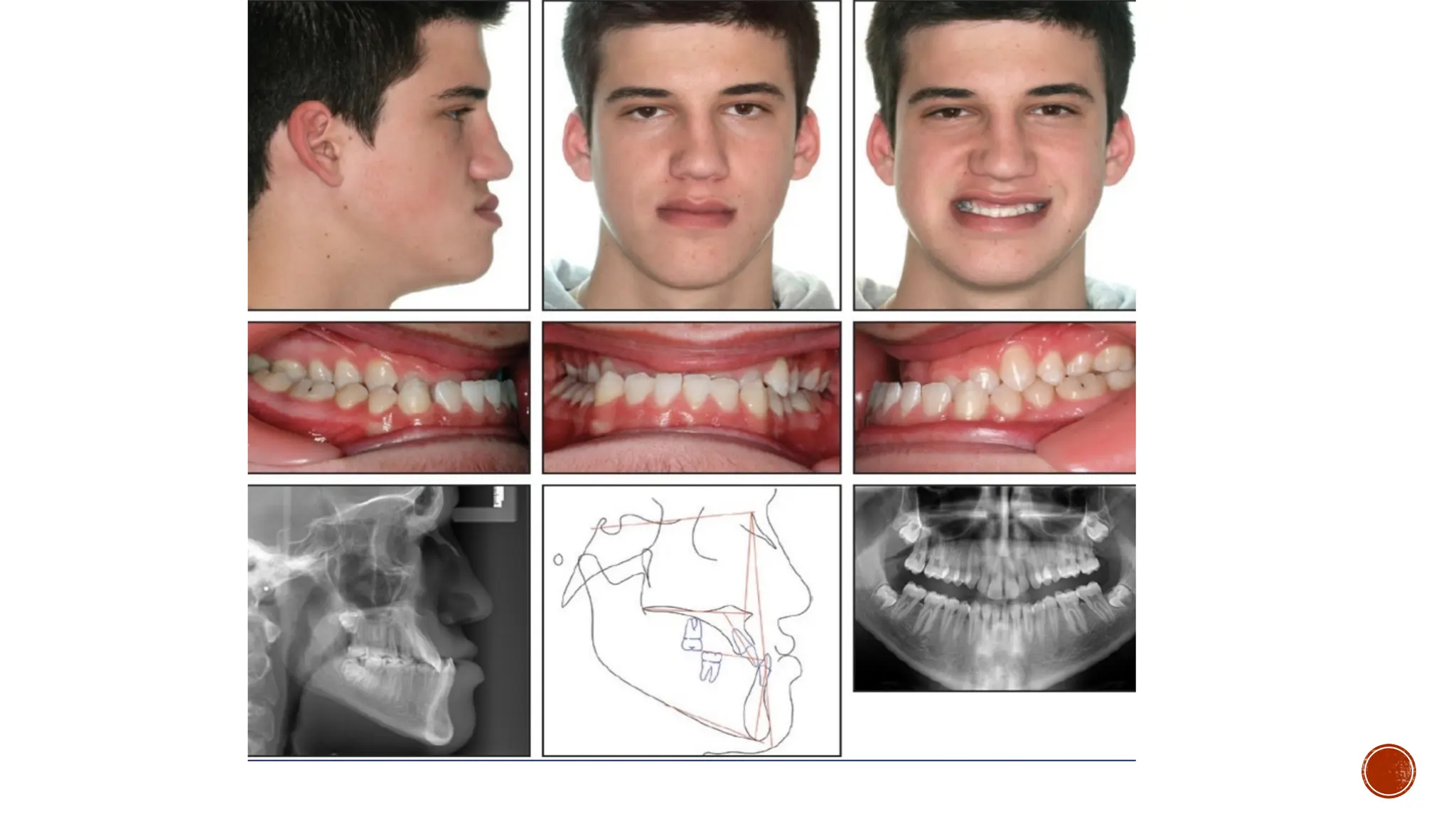 Class 3 malocclusion class III malocclusion profit
