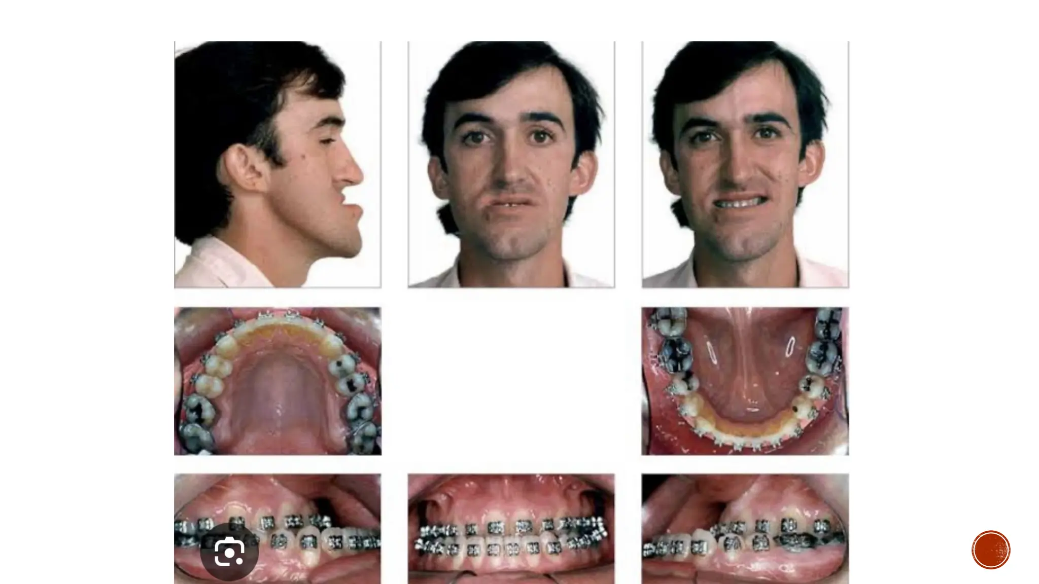 Class 3 malocclusion class III malocclusion profit
