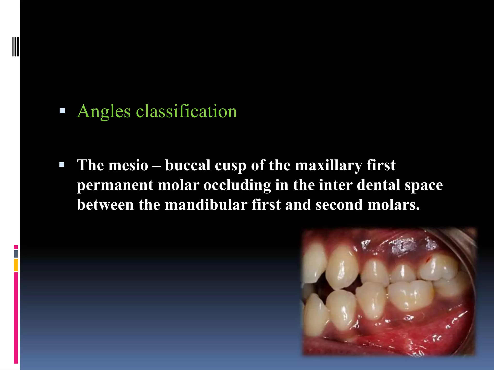  Angles classification
 The mesio – buccal cusp of the maxillary first
permanent molar occluding in the inter dental space
between the mandibular first and second molars.
 