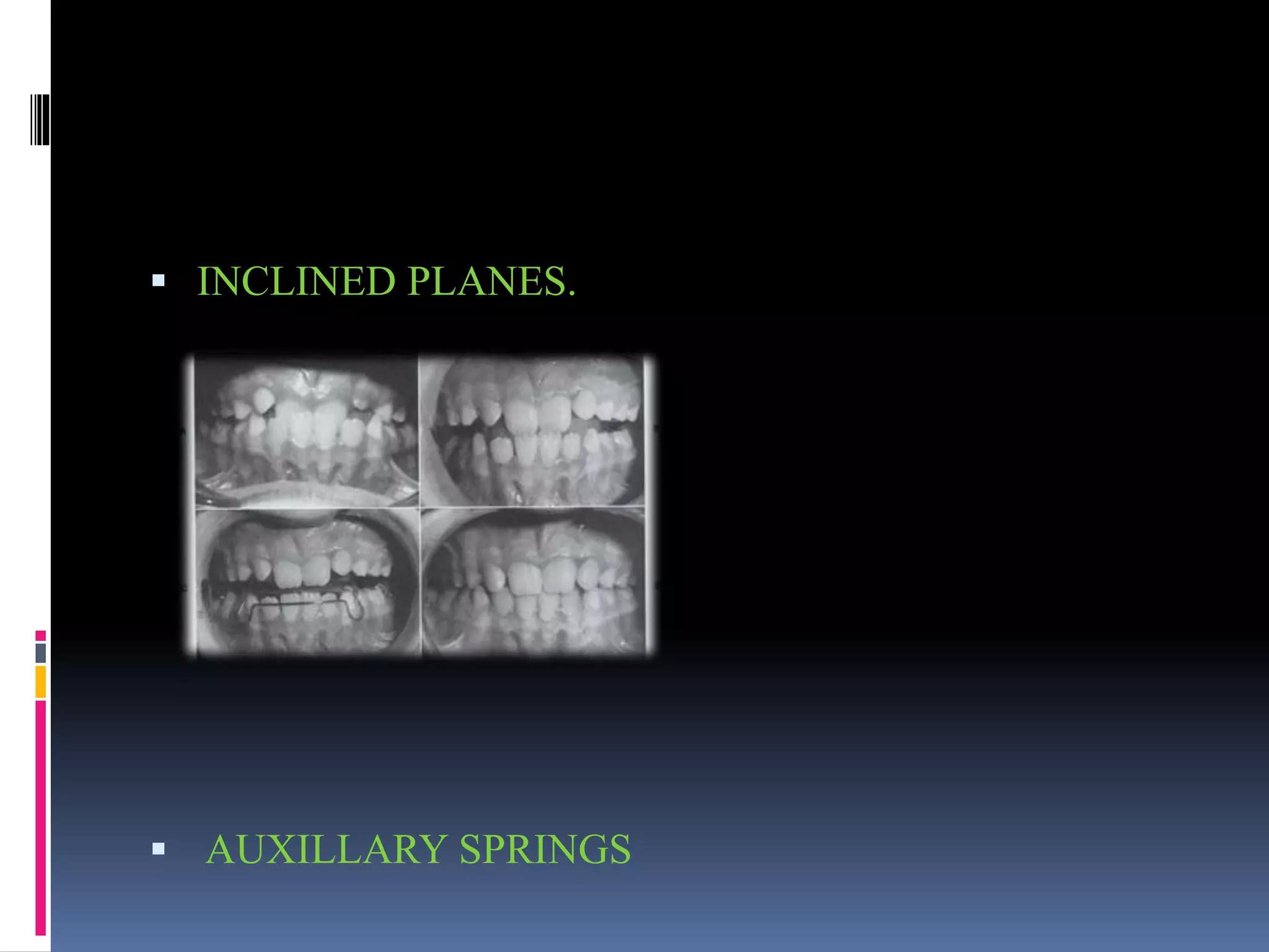  INCLINED PLANES.
 AUXILLARY SPRINGS
 