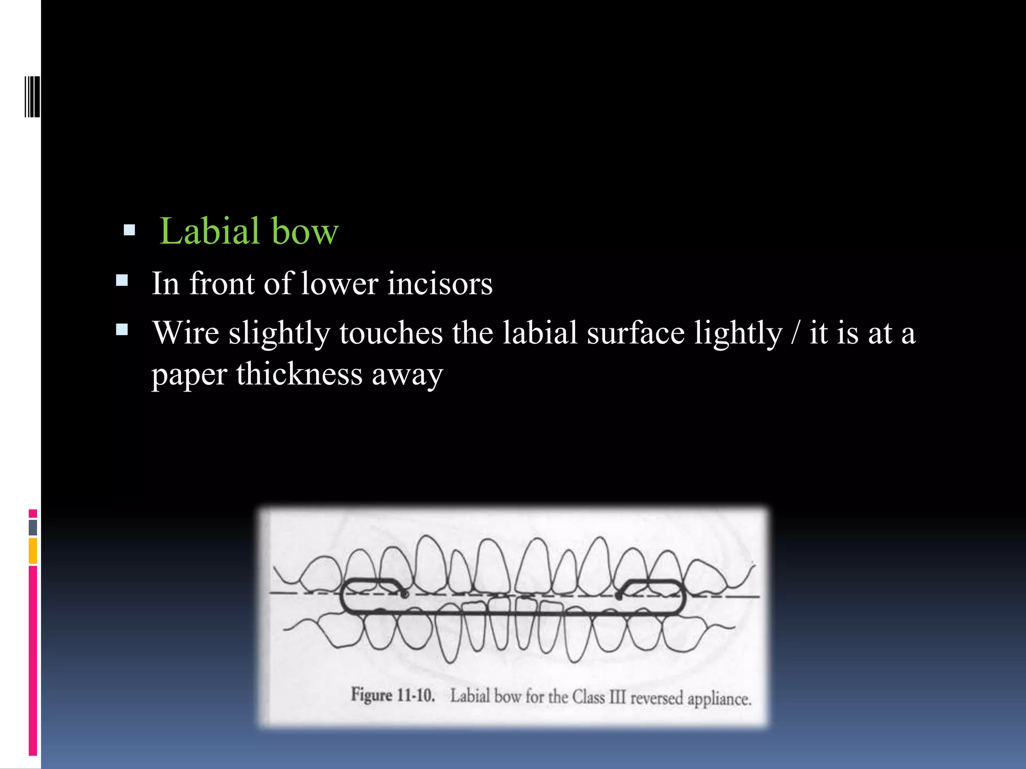  Labial bow
 In front of lower incisors
 Wire slightly touches the labial surface lightly / it is at a
paper thickness away
 