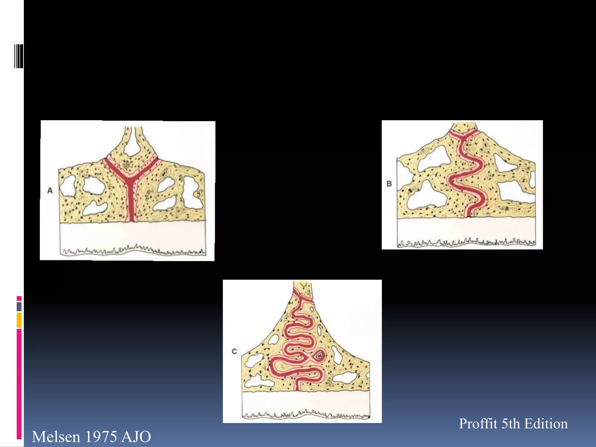 Melsen 1975 AJO
Proffit 5th Edition
 
