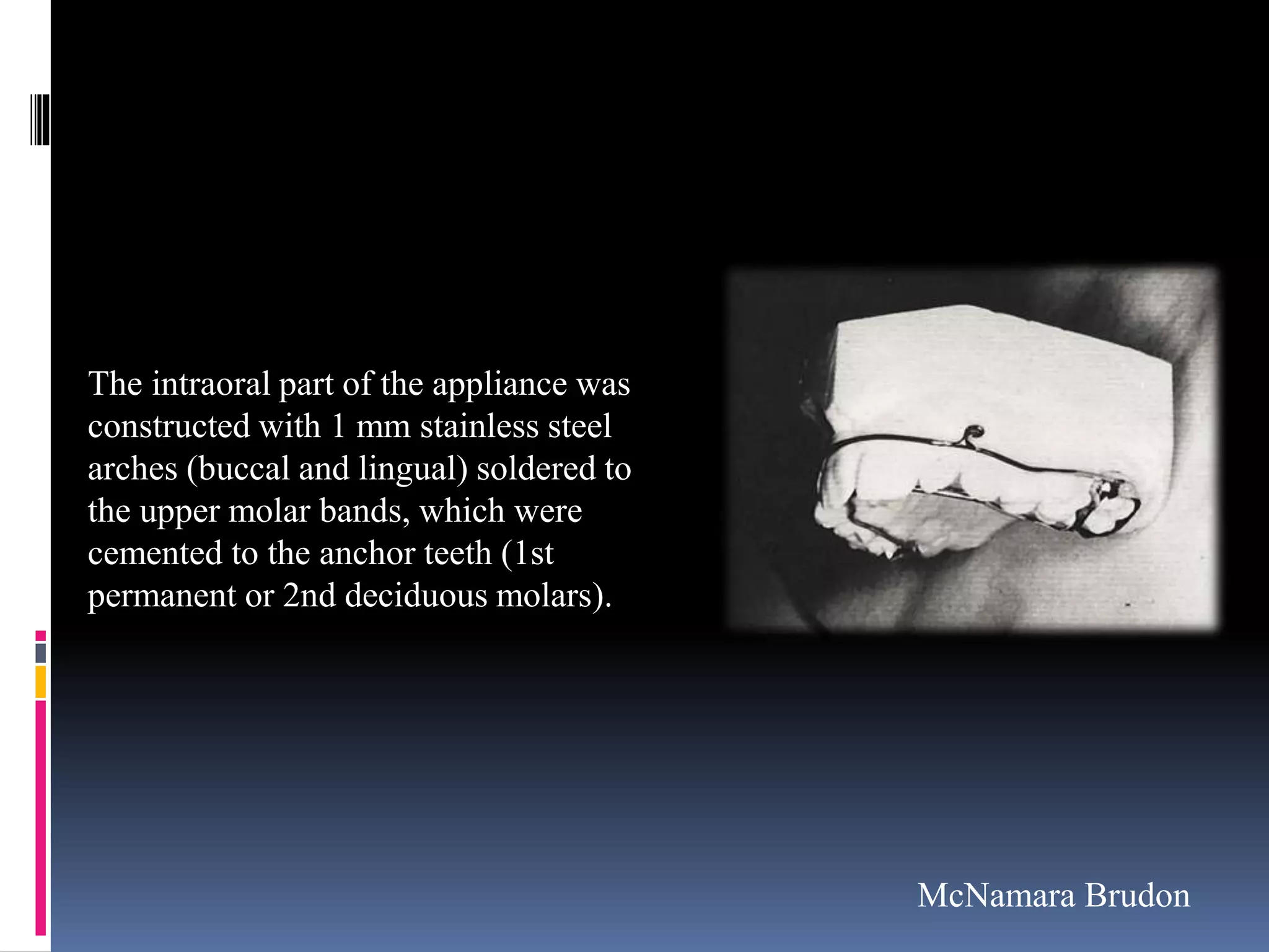The intraoral part of the appliance was
constructed with 1 mm stainless steel
arches (buccal and lingual) soldered to
the upper molar bands, which were
cemented to the anchor teeth (1st
permanent or 2nd deciduous molars).
McNamara Brudon
 