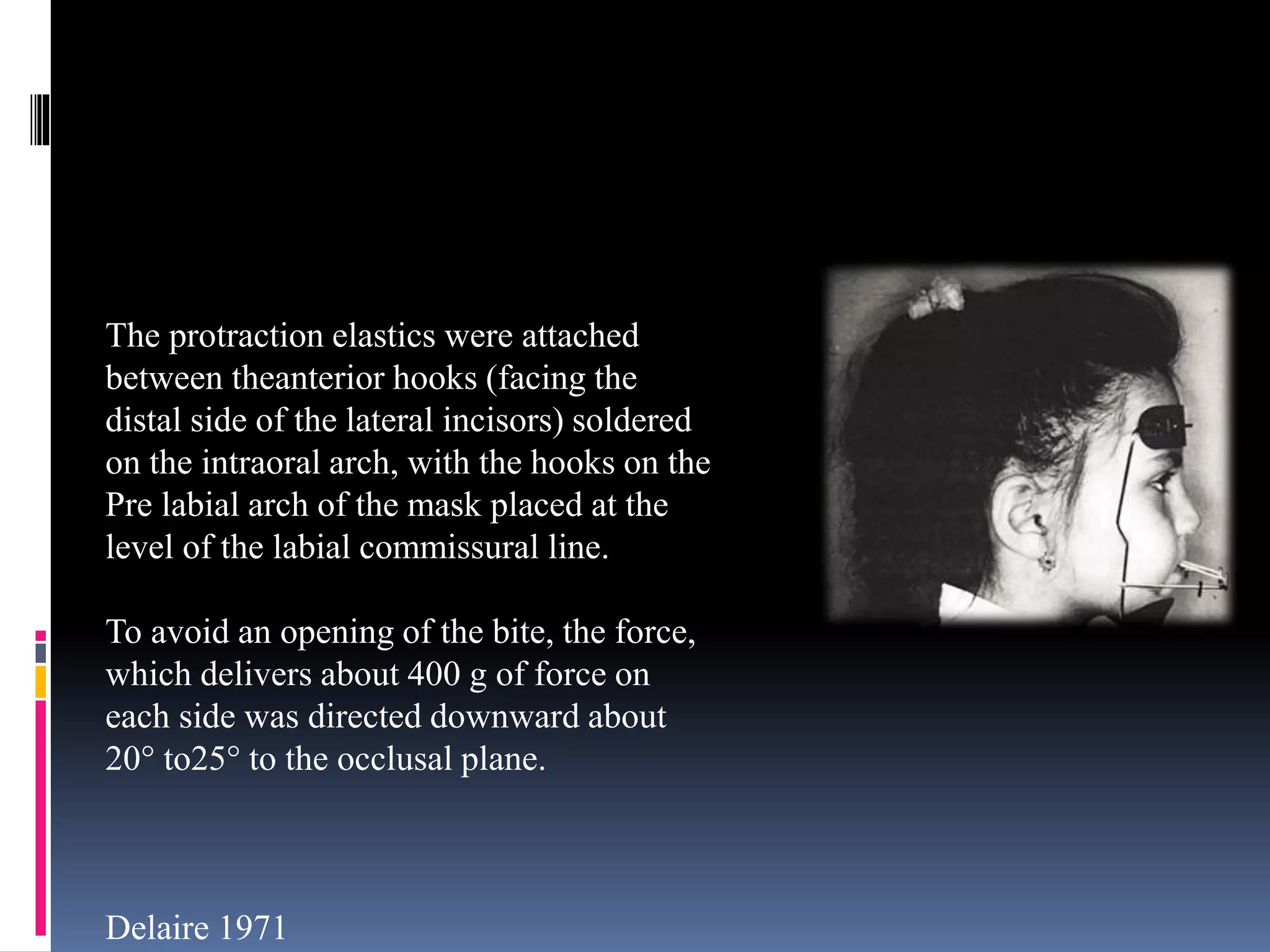 The protraction elastics were attached
between theanterior hooks (facing the
distal side of the lateral incisors) soldered
on the intraoral arch, with the hooks on the
Pre labial arch of the mask placed at the
level of the labial commissural line.
To avoid an opening of the bite, the force,
which delivers about 400 g of force on
each side was directed downward about
20° to25° to the occlusal plane.
Delaire 1971
 