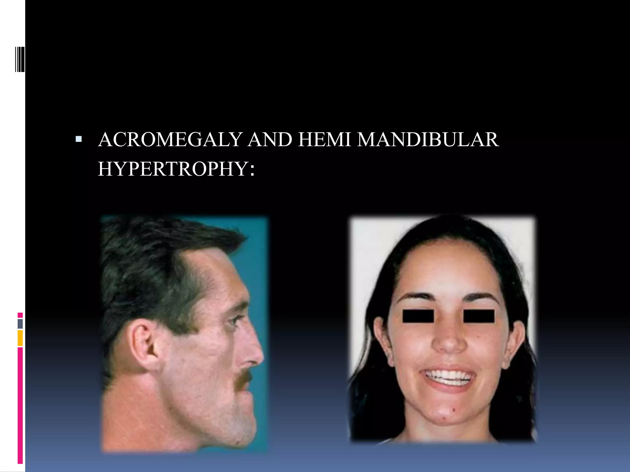  ACROMEGALY AND HEMI MANDIBULAR
HYPERTROPHY:
 