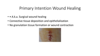 Primary Intention Wound Healing
• • A.k.a. Surgical wound healing
• Connective tissue deposition and epithelialization
• No granulation tissue formation or wound contraction
 