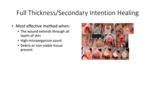 Full Thickness/Secondary Intention Healing
• Most effective method when:
• The wound extends through all
layers of skin
• High microorganism count
• Debris or non-viable tissue
present
 