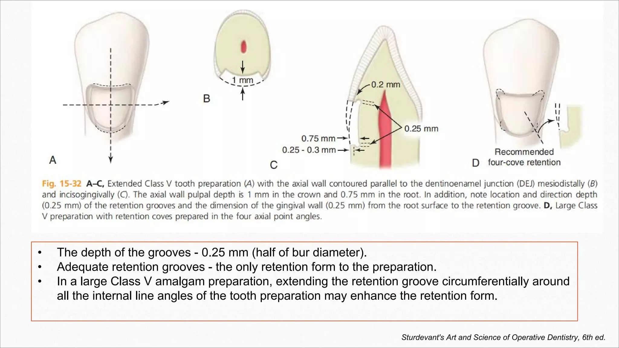• The depth of the grooves - 0.25 mm (half of bur diameter).
• Adequate retention grooves - the only retention form to the preparation.
• In a large Class V amalgam preparation, extending the retention groove circumferentially around
all the internal line angles of the tooth preparation may enhance the retention form.
Sturdevant's Art and Science of Operative Dentistry, 6th ed.
 