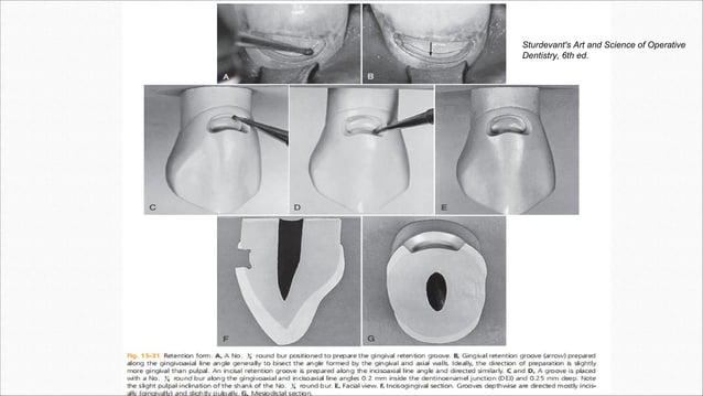 Class 5 cavity designs | PDF | Dental Health | Diseases and Conditions