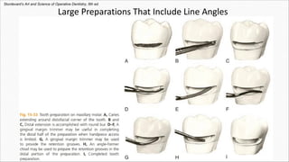 Large Preparations That Include Line Angles
Sturdevant's Art and Science of Operative Dentistry, 6th ed.
 