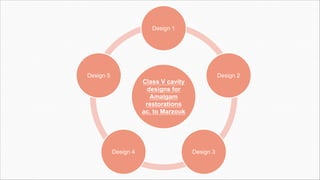 Class V cavity
designs for
Amalgam
restorations
ac. to Marzouk
Design 1
Design 2
Design 3
Design 4
Design 5
 