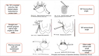 No. 331/2 inverted
cone bur, flat
bladed plastic
instrument to
protect dam
Straight and
smooth gingival
wall at right
angles to other
walls
Planing occlusal
wall with
wedelstaedt
chisel
900 Cavosurface
angle
900 axioocclusal
angle
Other walls
refined with
small
monoangled
chisel
Principles and Practice of Operative Dentistry- Charbeneau 3rd ed.
 