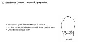 • Indications: Apical location of height of contour
• No clear demarcation between mesial, distal, gingival walls
• Limited inciso-gingival width
 