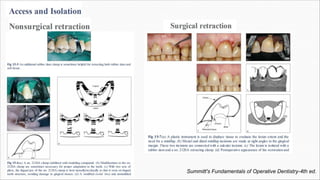 Class 5 cavity designs | PDF