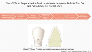 Class V Tooth Preparation for Small or Moderate Lesions or Defects That Do
Not Extend Onto the Root Surface
Class V (E and F) initial composite restorations (primary caries).
Restoring as
conservatively
No butt joints,
no groove
retention
Lesion is
scooped out
Divergent walls,
axial wall not
uniform in
depth
Initial tooth prep- round
diamond or carbide
bur eliminating the entire
enamel lesion
Dentin extension
only if necessary
Results in a
slightly bevelled
enamel margin
Sturdevant's Art and Science of Operative Dentistry, 6th ed.
 