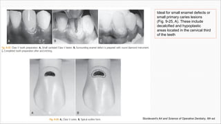 Ideal for small enamel defects or
small primary caries lesions
(Fig. 9-25, A). These include
decalcified and hypoplastic
areas located in the cervical third
of the teeth
Sturdevant's Art and Science of Operative Dentistry, 6th ed.
 