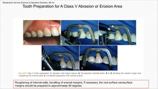 Tooth Preparation for A Class V Abrasion or Erosion Area
Roughening of internal walls, bevelling of enamel margins, If necessary, the root surface cavosurface
margins should be prepared to approximately 90 degrees
Sturdevant's Art and Science of Operative Dentistry, 6th ed.
 