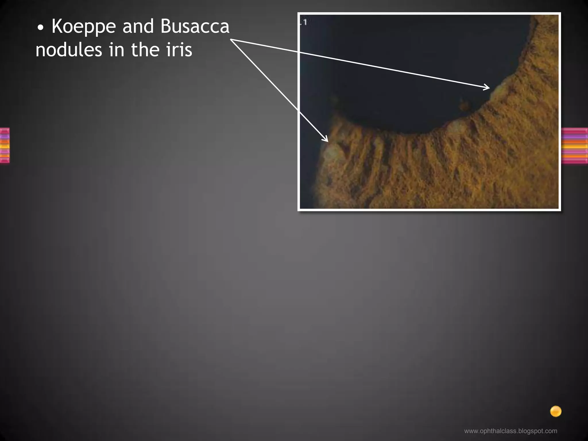  Koeppe and Busacca nodules in the iris Koeppe and Busacca nodules in the iris