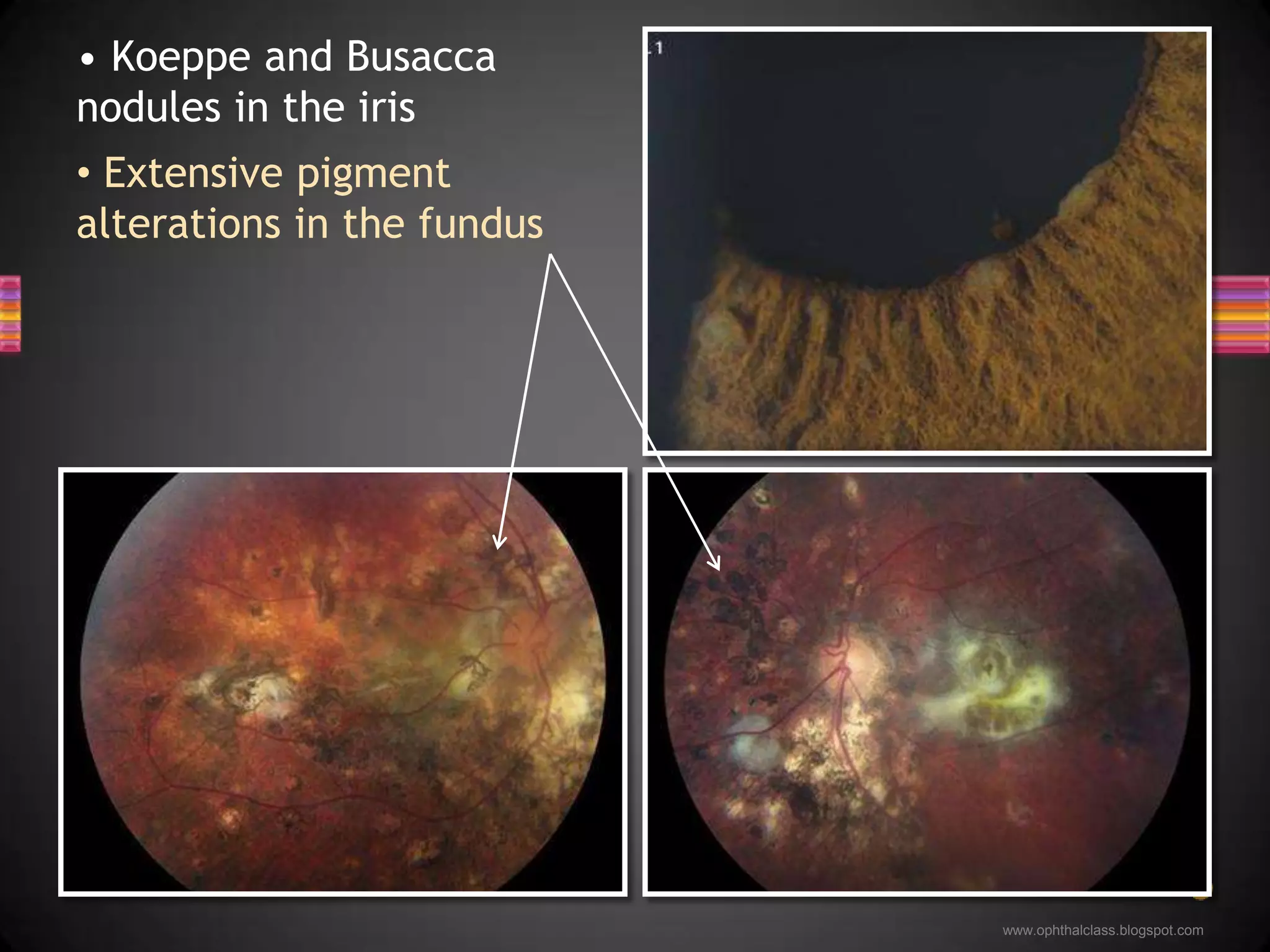  Extensive pigment alterations in the fundus Koeppe and Busacca nodules in the iris