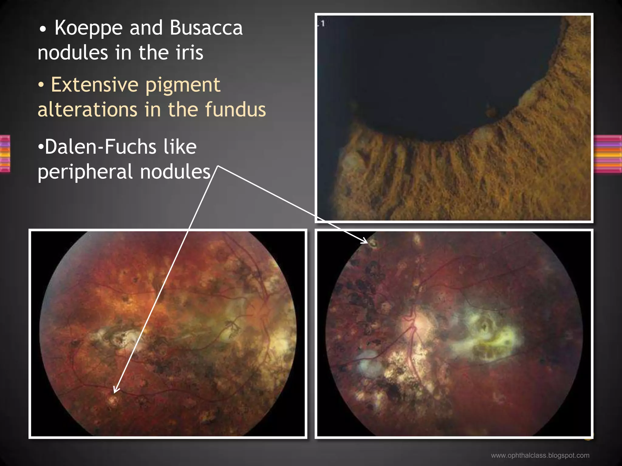  Extensive pigment alterations in the fundus