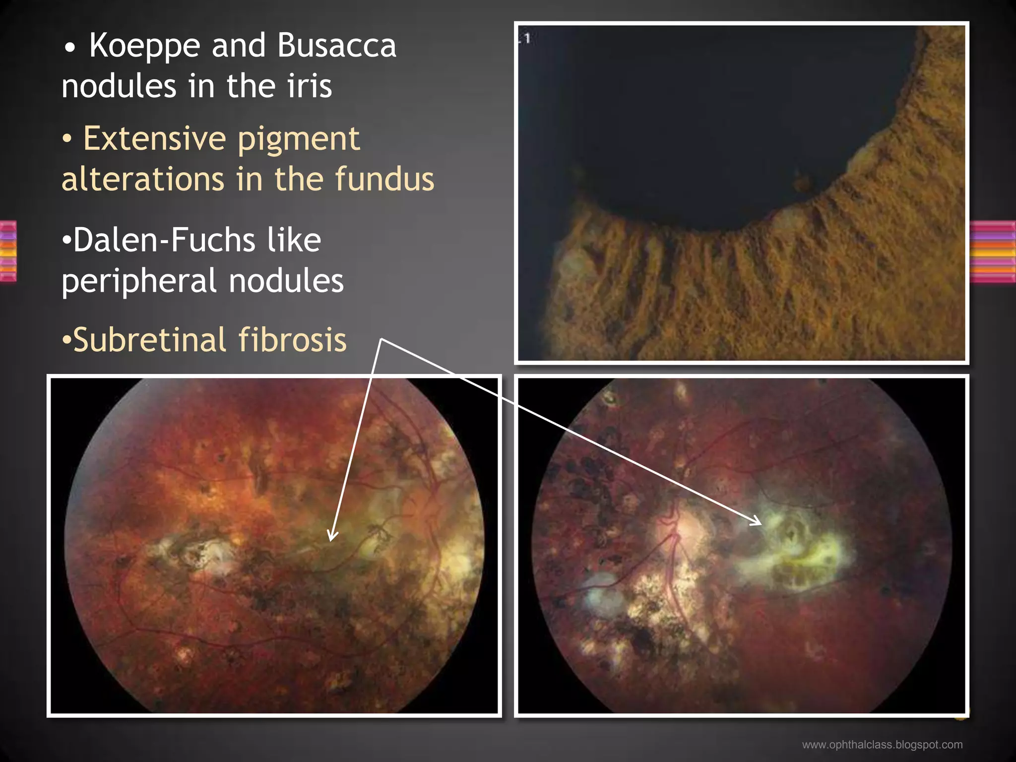 Dalen-Fuchs like peripheral nodules Koeppe and Busacca nodules in the iris