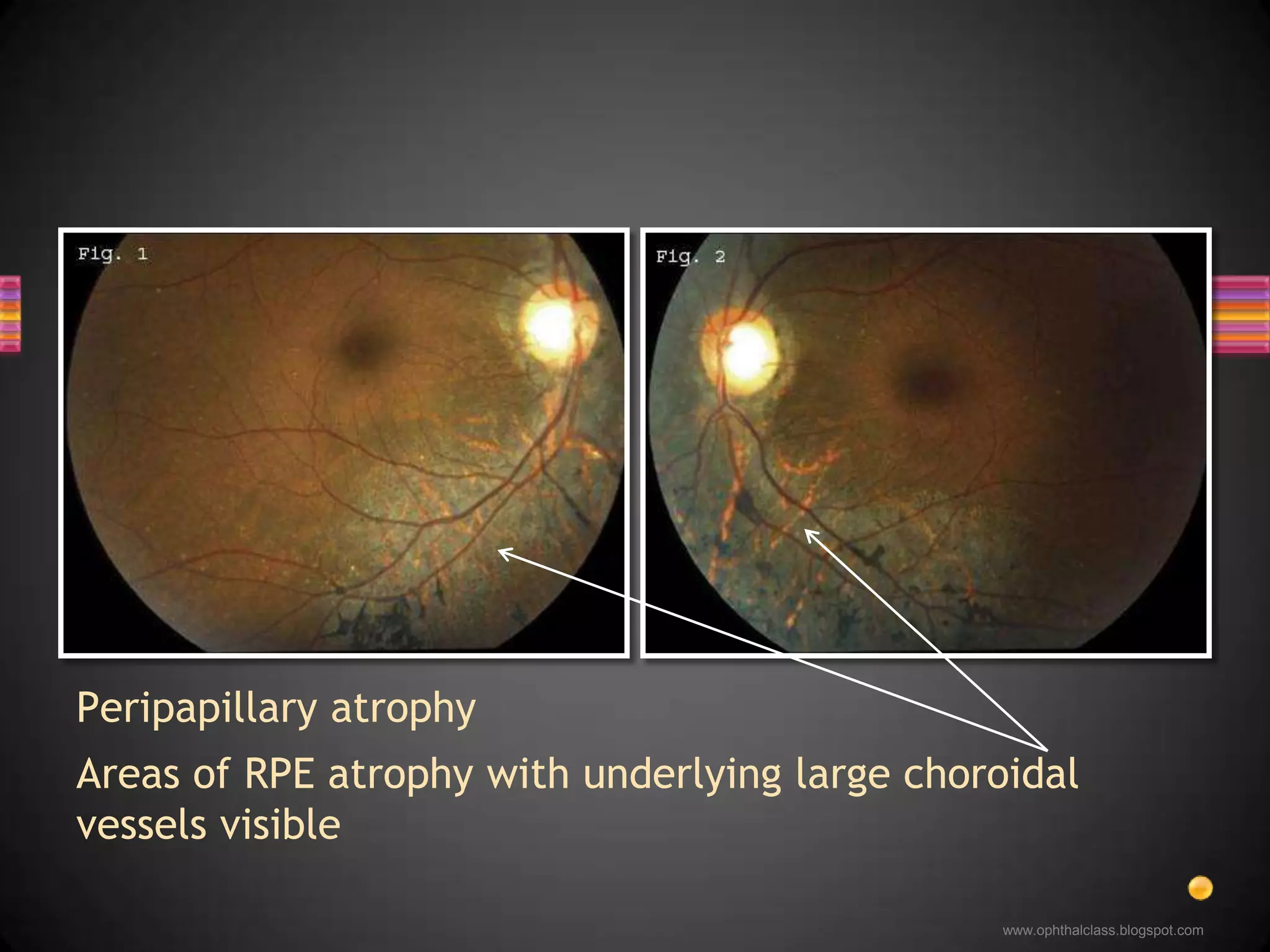 A 50 year old diabetic with blurry vision…http://www.aao.org/publications/eyenet/200710/am_rounds.cfm