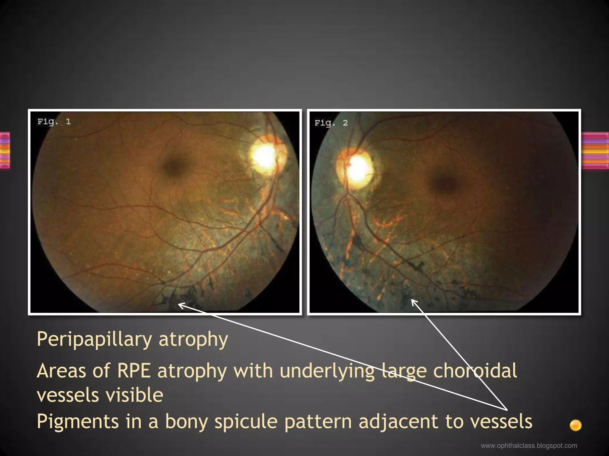 Peripapillary atrophy
