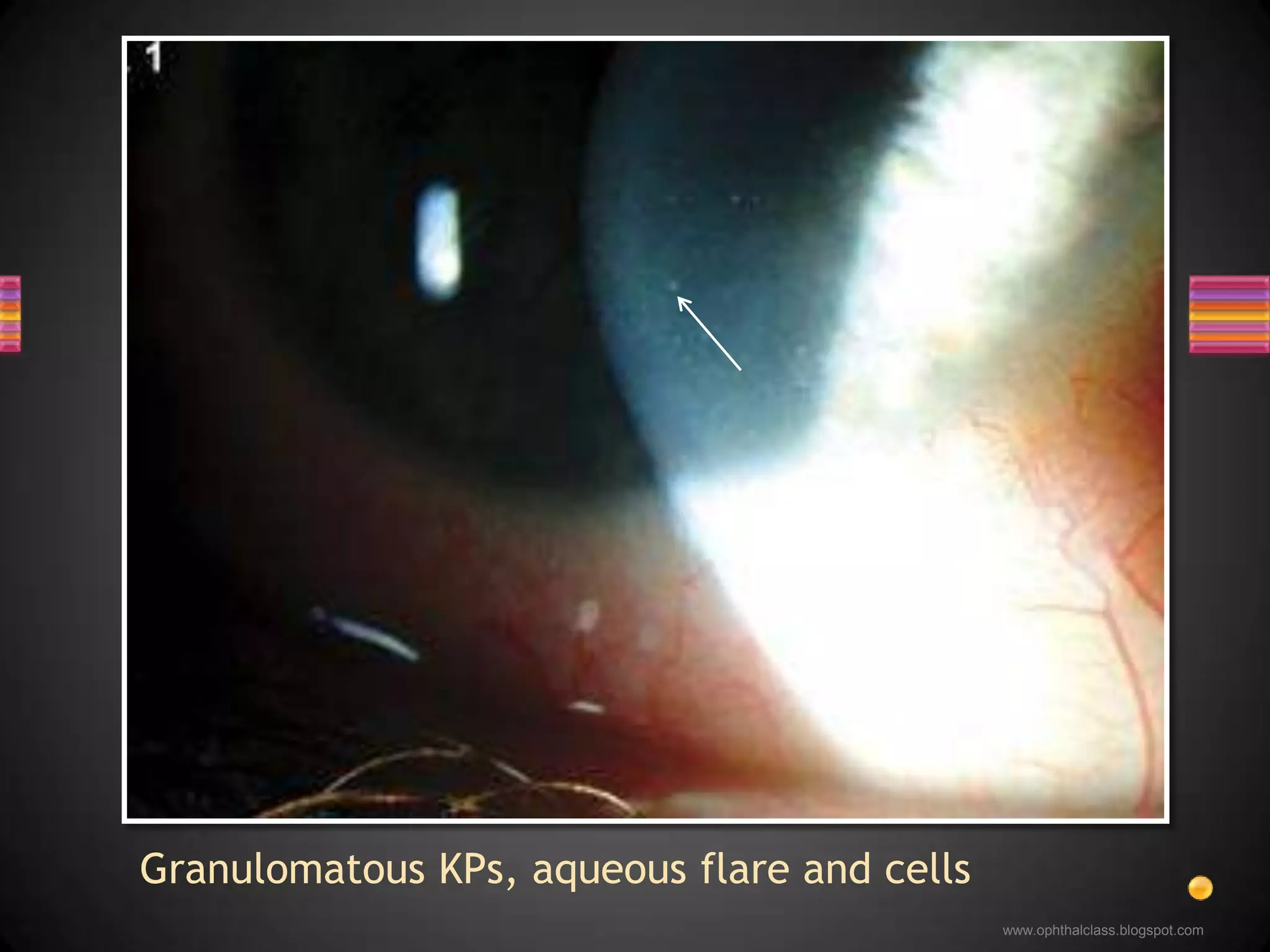 Chronic iridocyclitisGranulomatous / nongranulomatousChoroiditisFocal / multifocal / choroidal tuberclesRetinal vasculitis, vitritis, papillitisDifficulty - in establishing the diagnosis and ensuring treatment complianceTuberculosis 