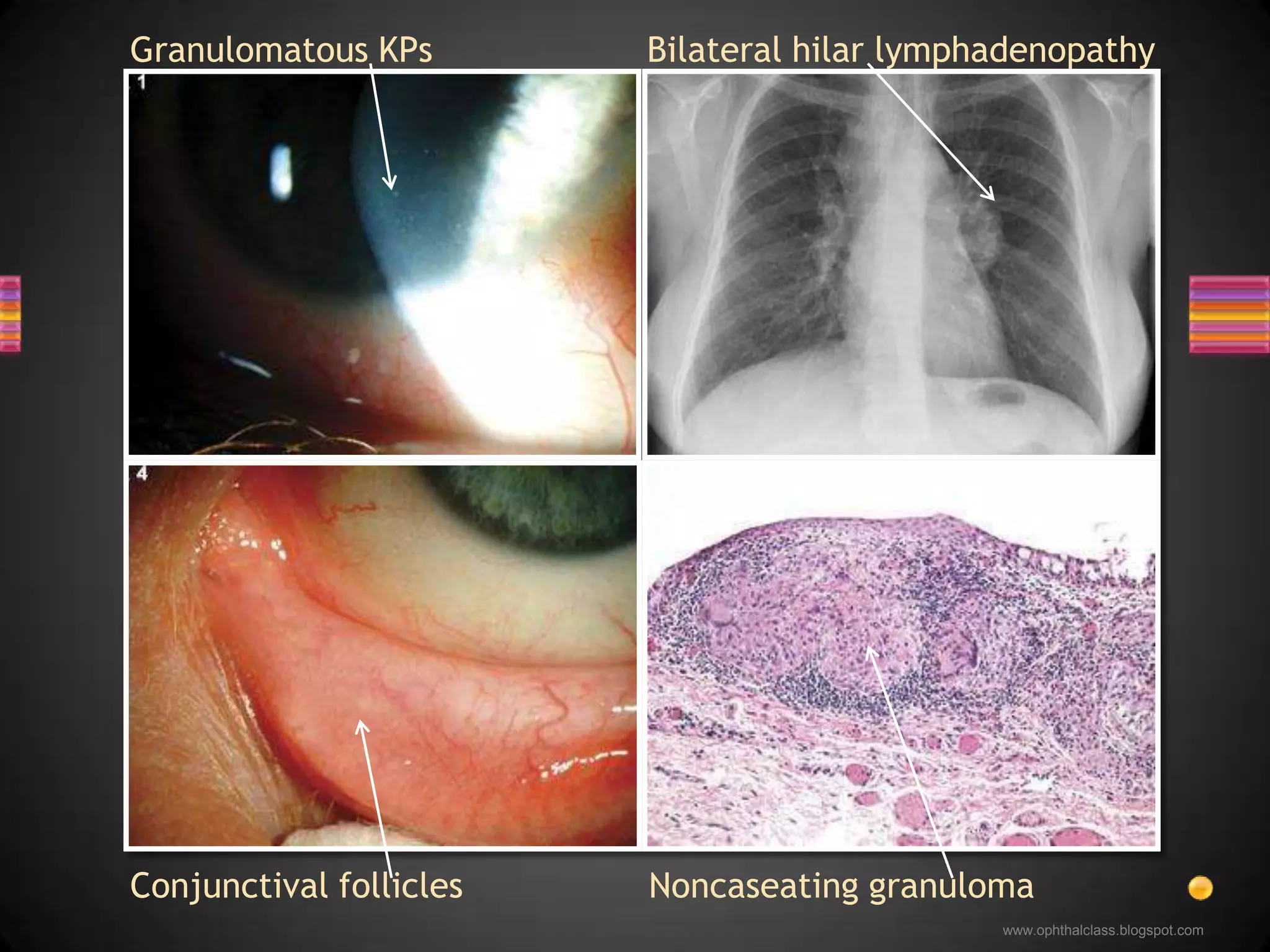 InfectionsTuberculosisSyphilisLyme diseaseNon-infectiousSarcoidosis VKH syndromeD/D granulomatous iridocyclitis