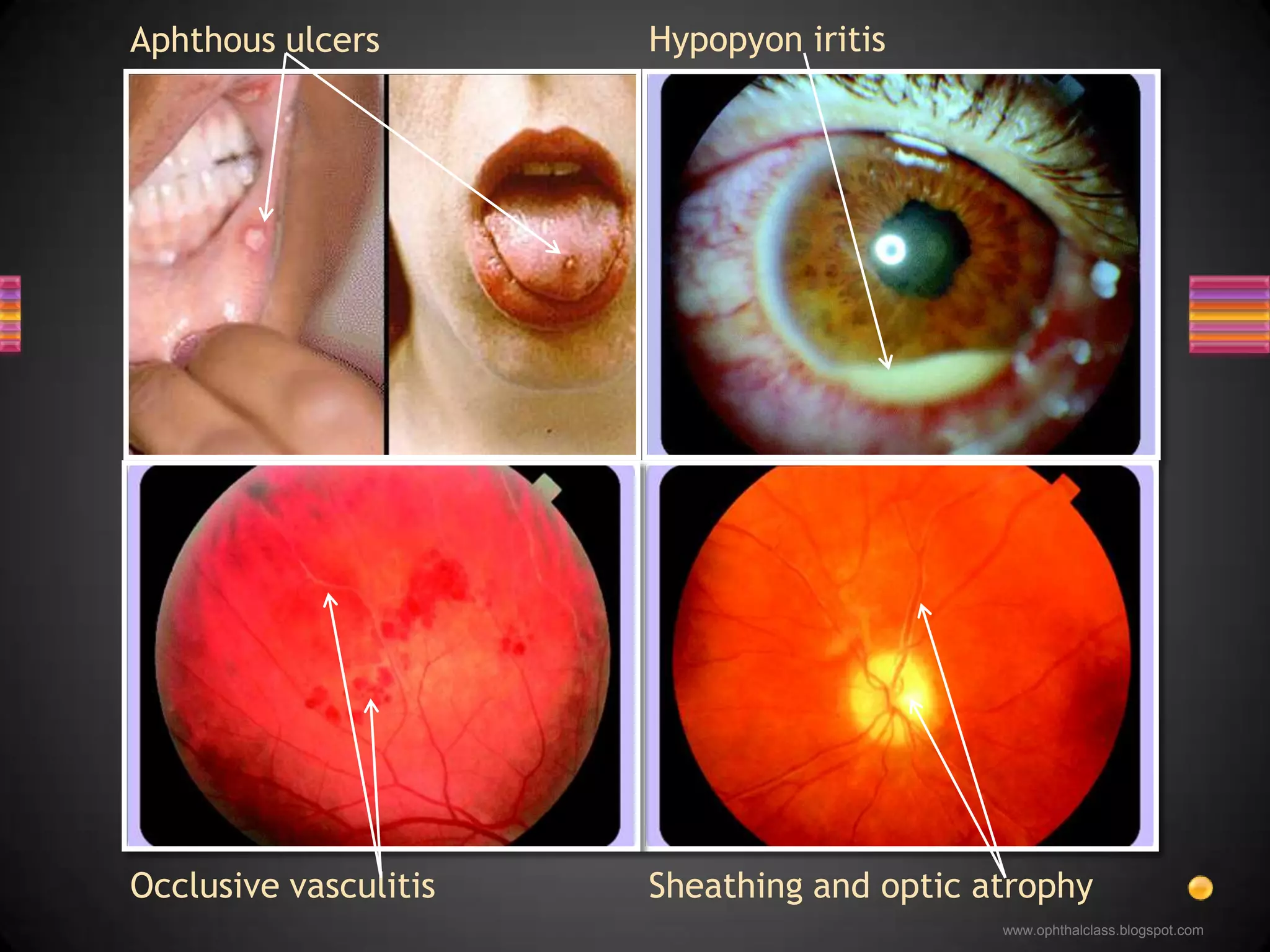 Suspect in any uveitisChest x-ray or CT, serum ACE and lysozymeBiopsy from skin / conjunctiva / lacrimal glandManagementCorticosteroids – topical, periocular and systemicImmunosuppressives may be requiredSarcoidosis 