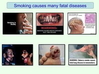 Smoking causes many fatal diseases
 
