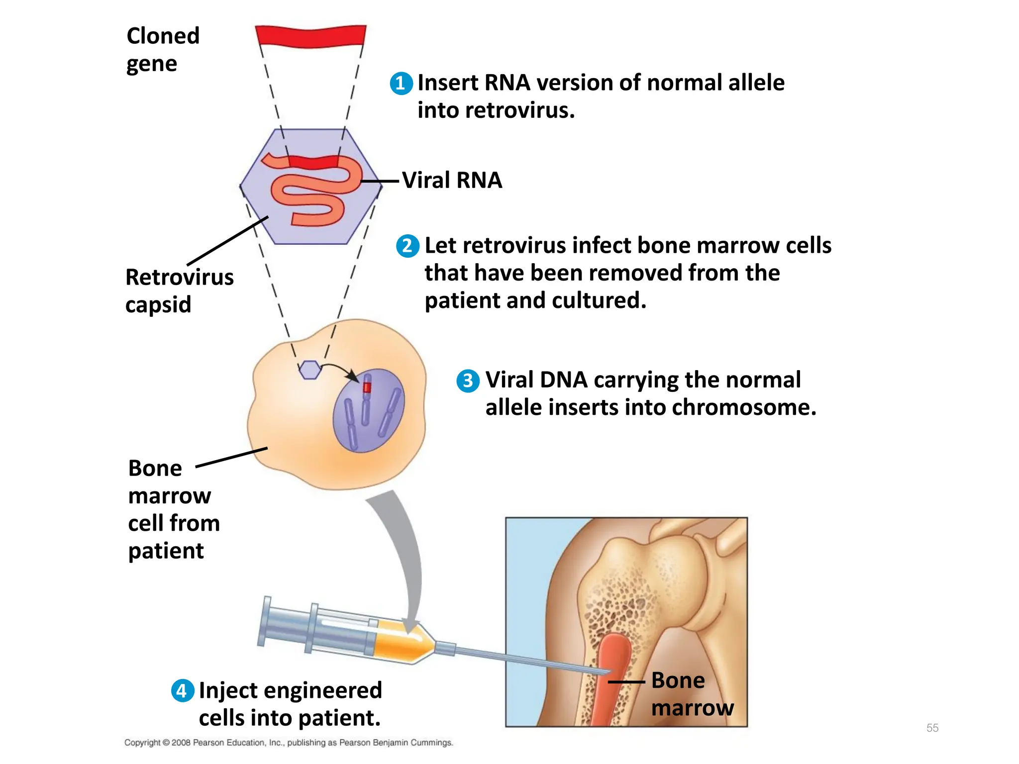 55
Bone
marrow
Cloned
gene
Bone
marrow
cell from
patient
Insert RNA version of normal allele
into retrovirus.
Retrovirus
capsid
Viral RNA
Let retrovirus infect bone marrow cells
that have been removed from the
patient and cultured.
Viral DNA carrying the normal
allele inserts into chromosome.
Inject engineered
cells into patient.
1
2
3
4
 