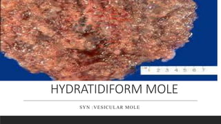 HYDRATIDIFORM MOLE
SYN :VESICULAR MOLE
 