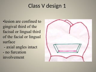 Comprehensive Guide to Class IV and Class V Dental Cavity Preparations ...