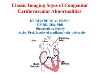 Classic Imaging Signs of Congenital
Cardiovascular Abnormalities
DR.RIYADH W. AL ESAWI
DMRD, MSc, PhD
Diagnostic radiology
Assist. Prof. faculty of medicine/kufa university
 